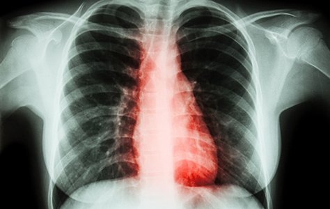 Insomnia - often caused by heart disease